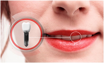 Dental Implant